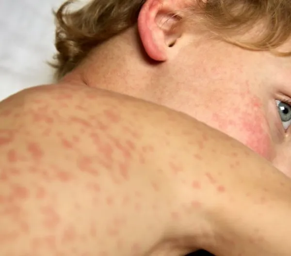 child sick with rubella lies covered with spots on a hospital bed