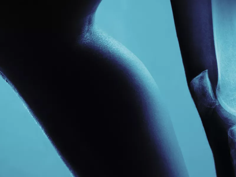 x-ray of a human knee