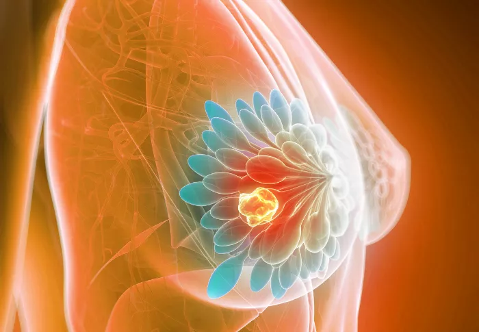 breast cancer