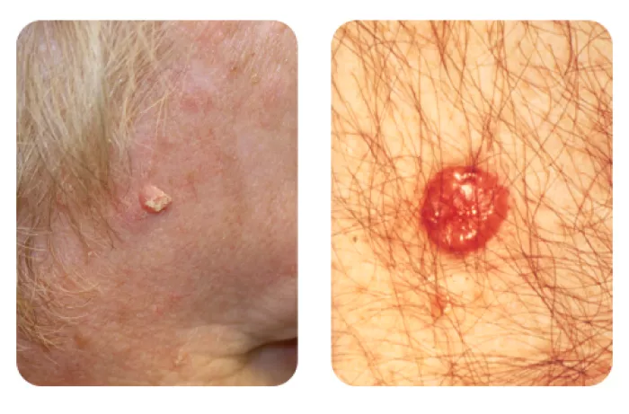 close up photos of squamous cell (left) and basal cell (right) cancers