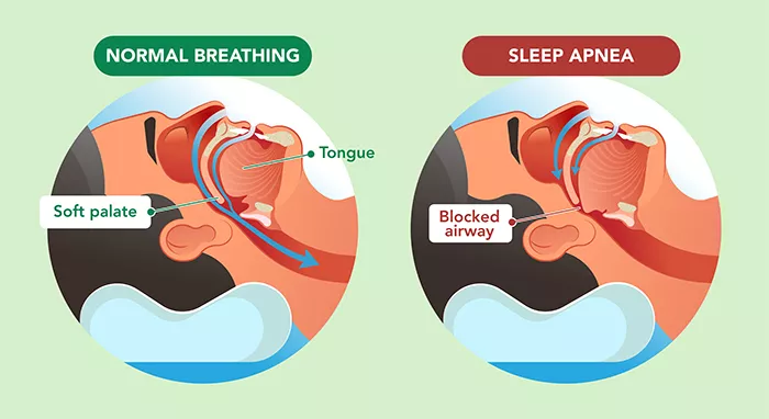 diagram of differences between normal breathing while sleeping and sleep apnea