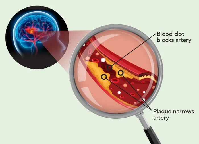 diagram of stroke starting in the brain