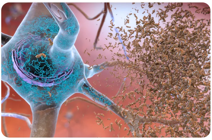 brown amaloyd plaques on neuron