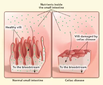 celiac damage diagram