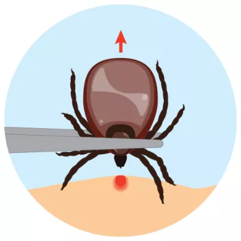cartoon tweezers pulling a tick of skin